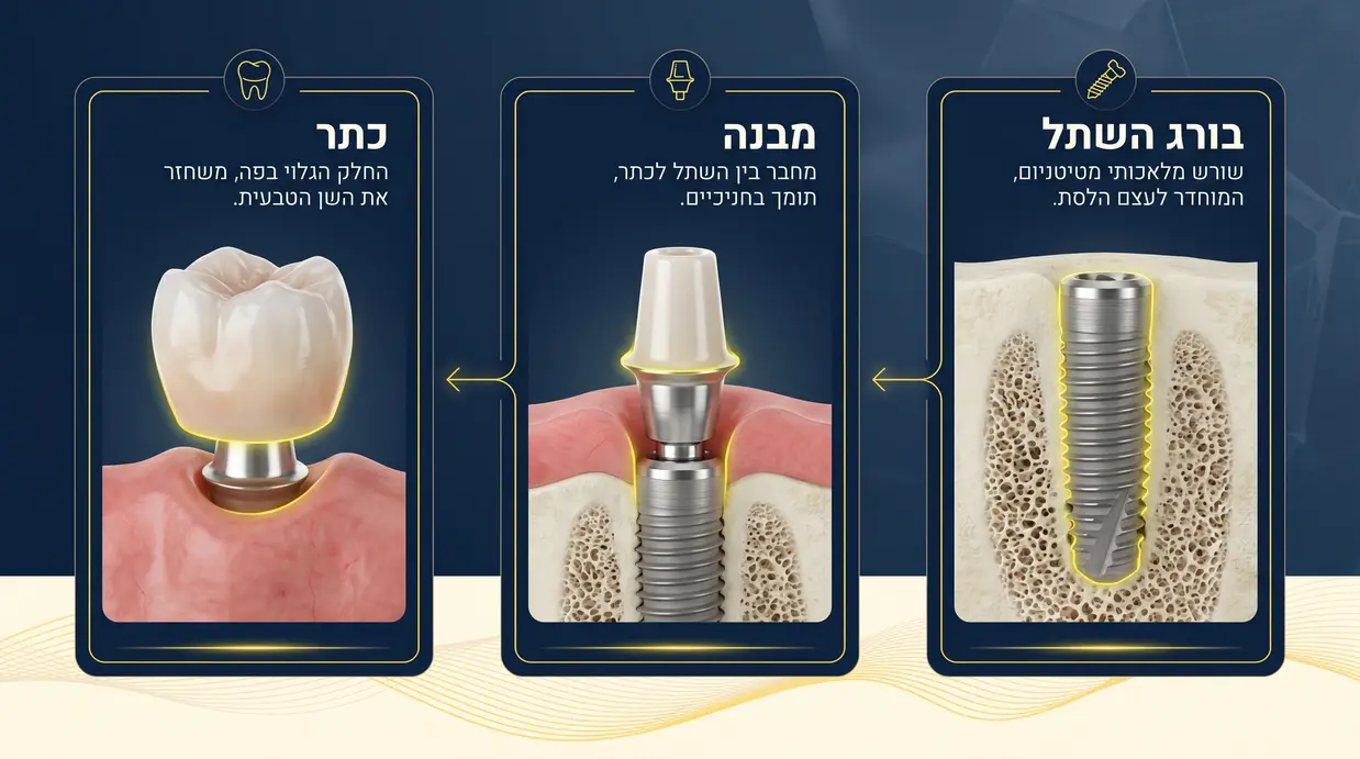 איור של מבנה שתל דנטלי עם חלקים מסומנים בעברית
